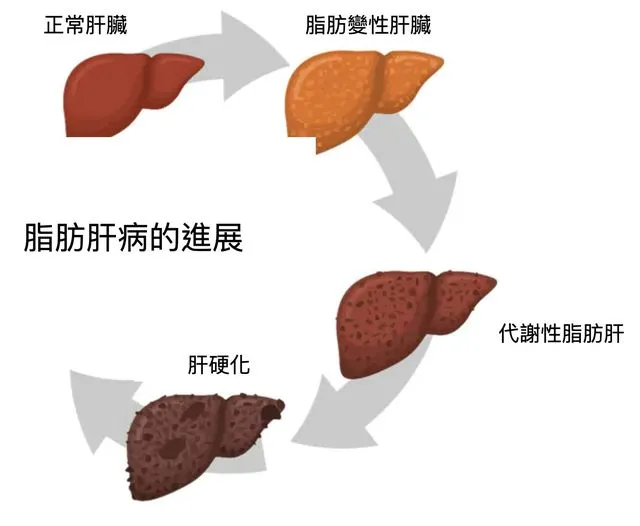 腹部超音波檢查說我有脂肪肝，什麼是脂肪肝？脂肪肝會惡化嗎？
